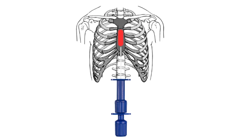 Einweg-Knochenmarkpunktionsnadel
